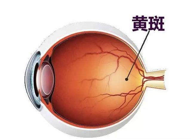 视物扭曲或有黑影当心黄斑病变,四类眼底病就医别拖延
